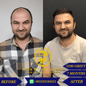 Before After - Hair Transplant
