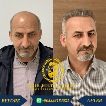 Before After - Hair Transplant