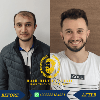 Before After - Hair Transplant