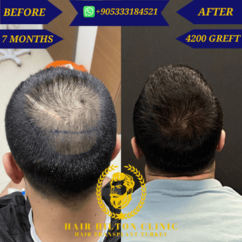 Before After - Hair Transplant