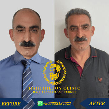 Before After - Hair Transplant