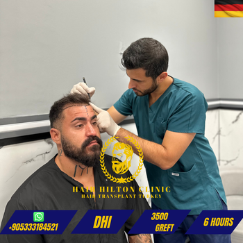 Before After - Hair Transplant