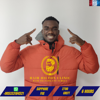 Before After - Hair Transplant