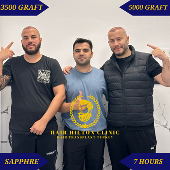 Before After - Hair Transplant