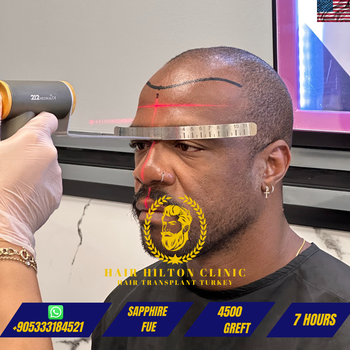 Before After - Hair Transplant