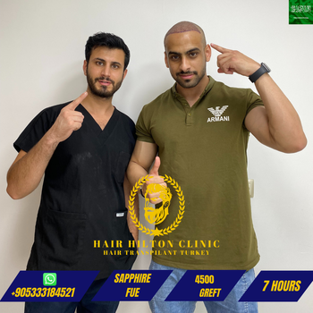 Before After - Hair Transplant