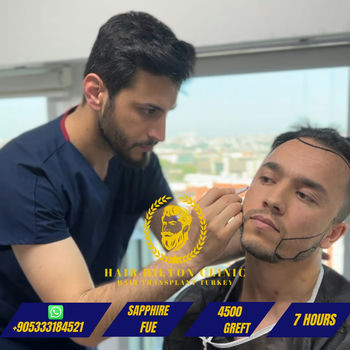 Before After - Hair Transplant