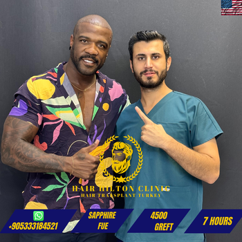 Before After - Hair Transplant